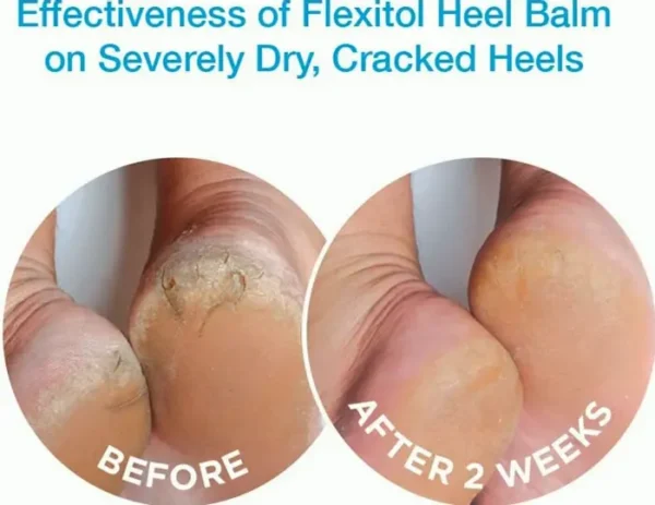 Flexitol Heel Balm 4 Oz Tube (Set of 2): Hydrating & Exfoliating